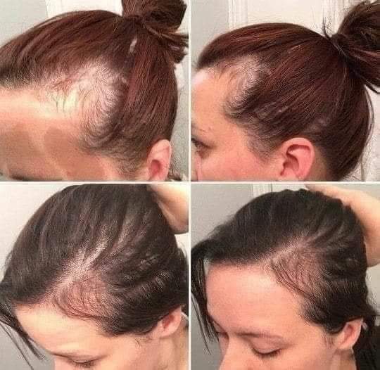 Shampoo Chile Anticaida | ℕ𝔼𝕂𝔸ℕ𝔼